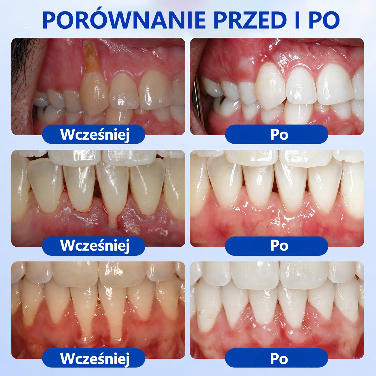 🦷🦷 𝑮𝒍𝒊𝒎𝒎𝒆𝒓𝒍𝒚® 𝑮𝒖𝒎𝑹𝒆𝒗𝒊𝒗𝒆 𝒁̇𝒆𝒍 𝒅𝒐 𝑹𝒆𝒈𝒆𝒏𝒆𝒓𝒂𝒄𝒋𝒊 𝑫𝒛𝒊𝒂̨𝒔𝒆ł
